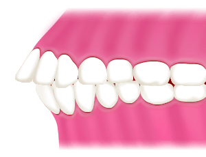 上顎前突（出っ歯・反っ歯）
